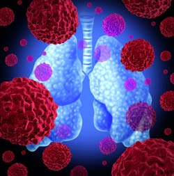 Cellule tumorali attaccano il polmone