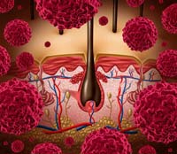I melanociti, cellule che contengono il pigmento melanina responsabile della colorazione della pelle, da cui origina il melanoma