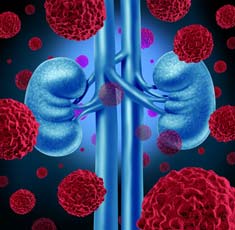 Cancer cells attack the kidneys